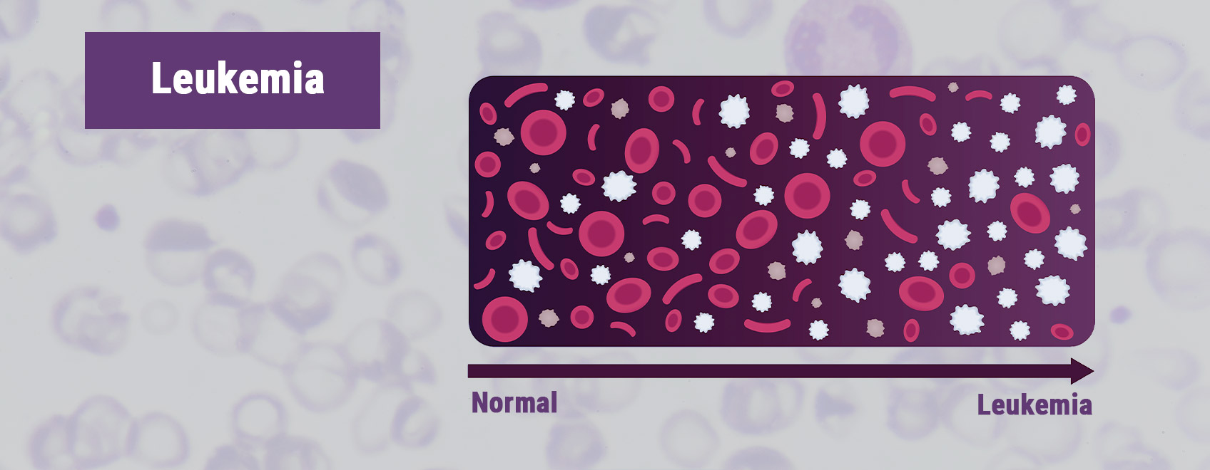 Leukemie Leukemie